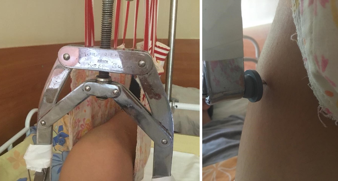 История. Как мальчика с переломом бедра поднимали на ноги в Беларуси и Швейцарии