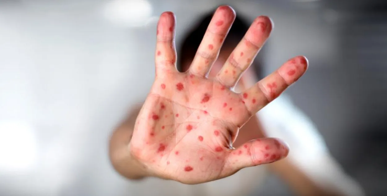 У Беларусі ўжо 241 выпадак адру, хварэлі нават прышчэпленыя