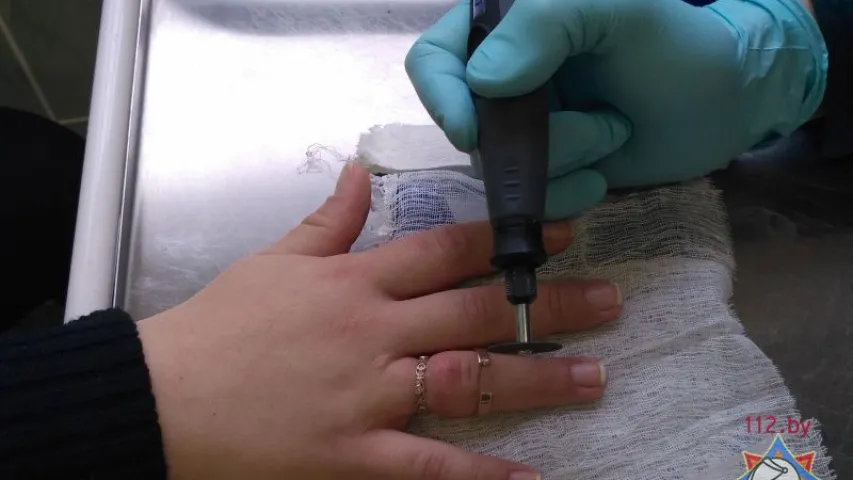 У Брэсце выклікалі МНС, каб зняць пярсцёнкі з пальца цяжарнай жанчыны